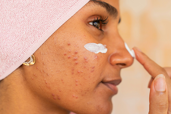 face skincare acne spots skin problems acne scars skin blemish