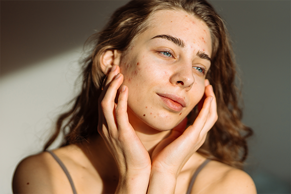 Woman with problem skin on her face. Medicine and cosmetology concept. Natural skin.