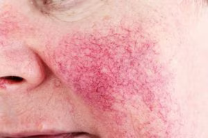 Rosacea: causes, symptoms and treatments