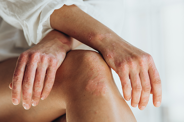Psoriasis. Acute psoriasis on the knees, body, elbows is an autoimmune, incurable dermatological skin disease. Large, red, inflamed, scaly rash.