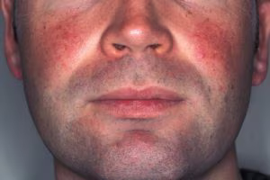 Rosacea: causes, symptoms and treatments
