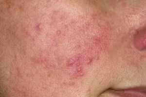 Rosacea: causes, symptoms and treatments