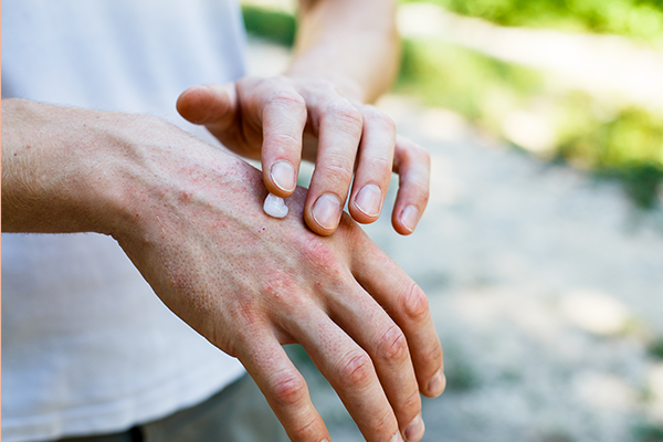 applying an cream emollient to dry flaky skin as in the treatment of psoriasis, eczema and other dry skin conditions