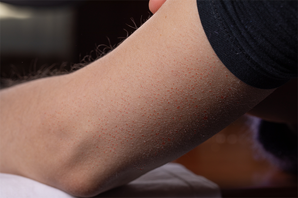 Arm close up with red skin rash on the back