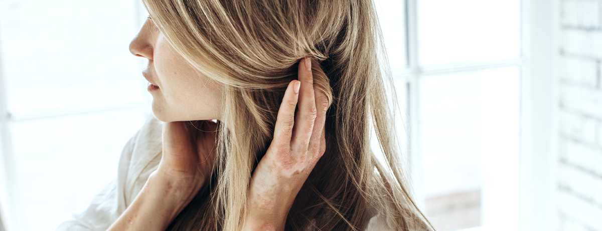Psoriasis, a skin disease in a young woman, a hair problem.