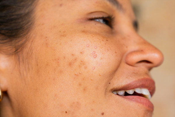Female with acne smiling facing away from camera