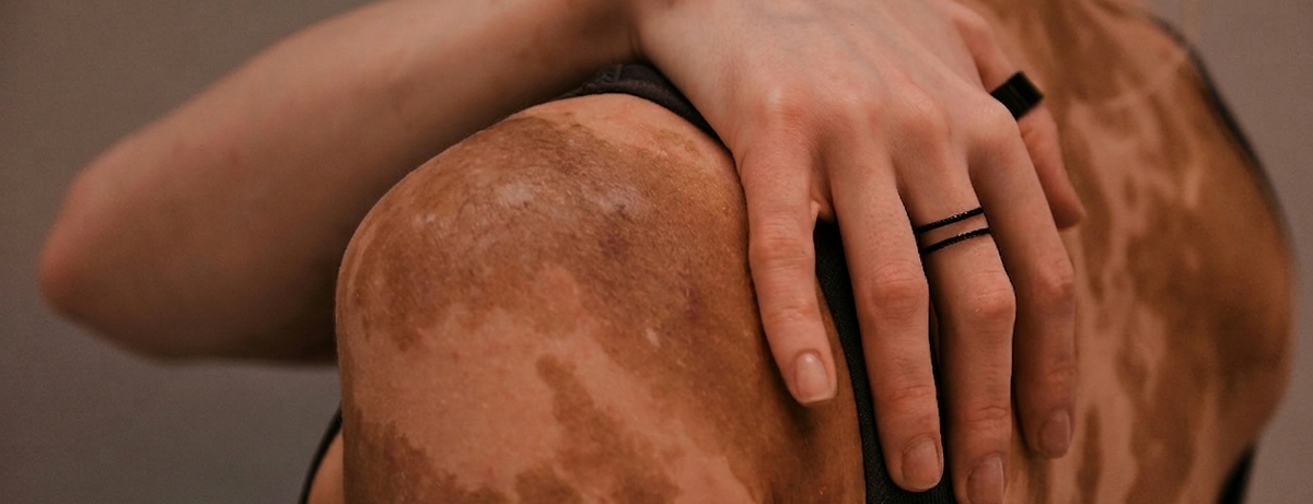 Close up of a womens shoulder with hyperpigmentation visible on skin